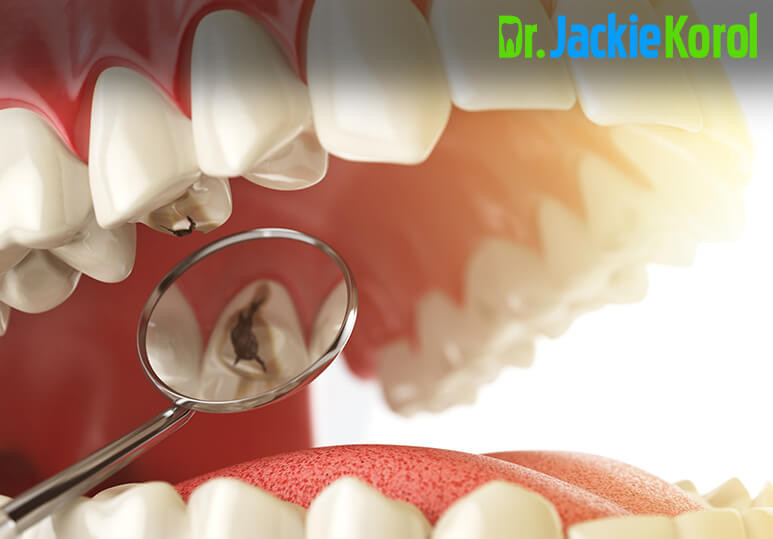 What To ﻿Do If Your Tooth Filling Falls Out|Calgary Emergency Dentistry